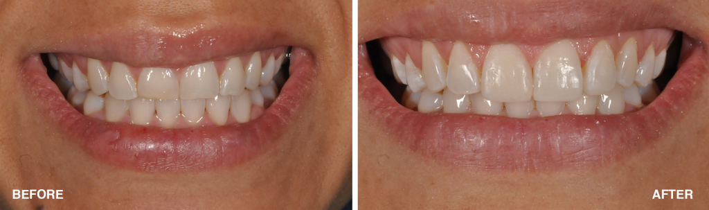 Esthetic Bonding – Aventura Dental Arts