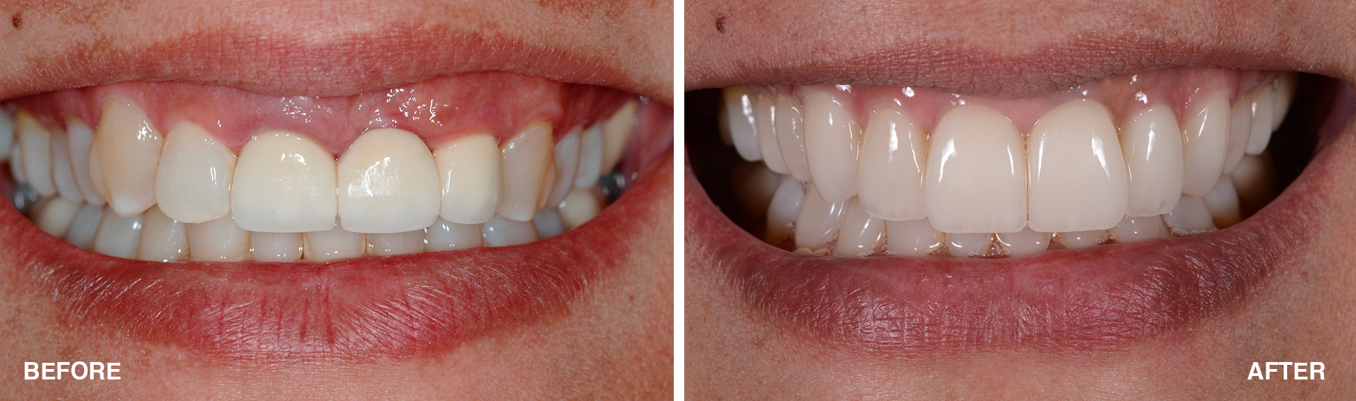 Teeth whitening procedure video
